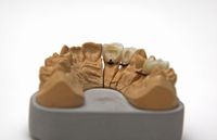 Weber Zahntechnik, Ravensburg, Unterkiefer, Zahnprothese, Implantate, Zahnabdruck, Zahnimplantate, Br&uuml;cken, Veneers